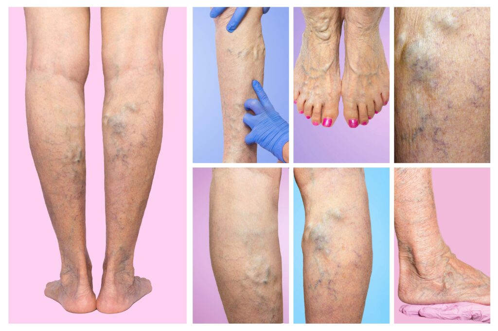 découvrez comment gérer les varices pendant la grossesse : causes, prévention et traitements pour les femmes enceintes. prenez soin de vos jambes tout en portant la vie!