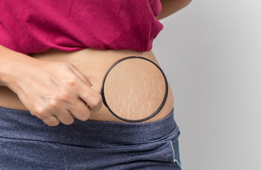 découvrez des remèdes naturels efficaces pour lutter contre la cellulite pendant la grossesse. optez pour des solutions douces et sûres pour apaiser votre peau tout en vous sentant bien dans votre corps.