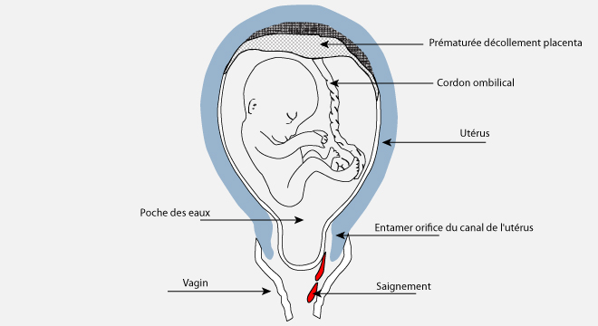 découvrez les causes, les symptômes et les conseils pour surmonter une fausse couche précoce. informez-vous sur les enjeux émotionnels et physiques et trouvez du soutien dans cette épreuve difficile.